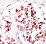 Formalin-fixed and paraffin-embedded human cancer tissue reacted with the primary antibody, which was peroxidase-conjugated to the secondary antibody, followed by DAB staining. This data demonstrates the use of this antibody for immunohistochemistry; clinical relevance has not been evaluated. BC = breast carcinoma; HC = hepatocarcinoma.
