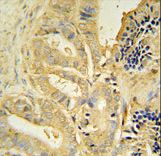 TLL1 antibody immunohistochemistry of formalin-fixed and paraffin-embedded human prostate carcinoma followed by peroxidase-conjugated secondary antibody and DAB staining.