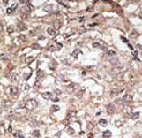 Formalin-fixed and paraffin-embedded human cancer tissue reacted with the primary antibody, which was peroxidase-conjugated to the secondary antibody, followed by AEC staining. This data demonstrates the use of this antibody for immunohistochemistry; clinical relevance has not been evaluated. BC = breast carcinoma; HC = hepatocarcinoma.