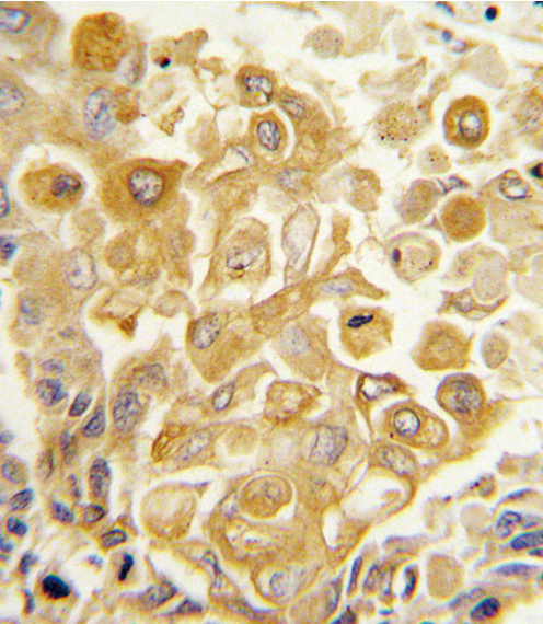 Formalin-fixed and paraffin-embedded human lung carcinoma tissue reacted with TLR2 antibody , which was peroxidase-conjugated to the secondary antibody, followed by DAB staining. This data demonstrates the use of this antibody for immunohistochemistry; clinical relevance has not been evaluated.
