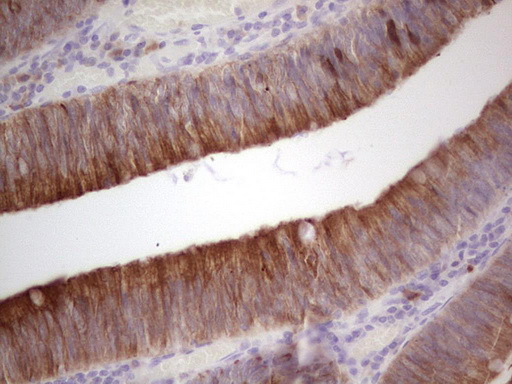 IHC of paraffin-embedded Adenocarcinoma of Human colon tissue using anti-PYDC1 mouse monoclonal antibody. (heat-induced epitope retrieval by 1 mM EDTA in 10mM Tris, pH8.5, 120°C for 3min).