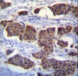 PALM3 Antibody immunohistochemistry of formalin-fixed and paraffin-embedded human bladder carcinoma followed by peroxidase-conjugated secondary antibody and DAB staining.