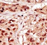 Formalin-fixed and paraffin-embedded human cancer tissue reacted with the primary antibody, which was peroxidase-conjugated to the secondary antibody, followed by DAB staining. This data demonstrates the use of this antibody for immunohistochemistry; clinical relevance has not been evaluated. BC = breast carcinoma; HC = hepatocarcinoma.