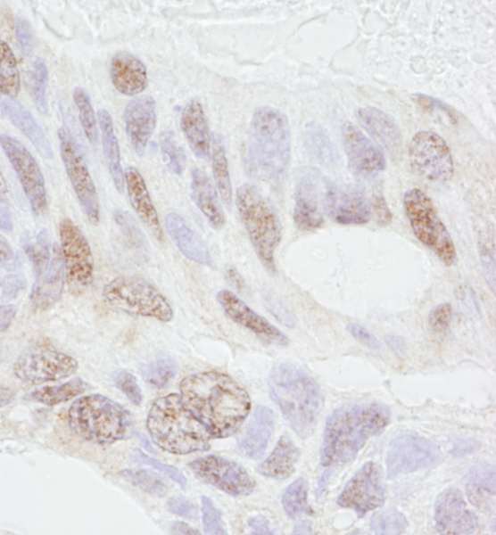 Detection of Human REA by Immunohistochemistry. Sample: FFPE section of human ovarian carcinoma. Antibody: Affinity purified rabbit anti-REA used at a dilution of 1:1000 (1 ug/ml). Detection: DAB.
