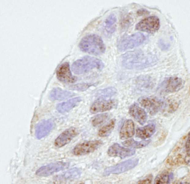 Detection of Human REA by Immunohistochemistry. Sample: FFPE section of human ovarian carcinoma. Antibody: Affinity purified rabbit anti-REA used at a dilution of 1:250. Detection: DAB.