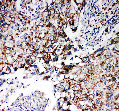 Prohibitin 2 / PHB2 antibody. IHC(P): Human Lung Cancer Tissue.
