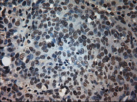 IHC of paraffin-embedded Adenocarcinoma of ovary tissue using anti-PROM2 mouse monoclonal antibody. (Dilution 1:50).