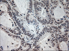 IHC of paraffin-embedded Adenocarcinoma of colon tissue using anti-PROM2 mouse monoclonal antibody. (Dilution 1:50).