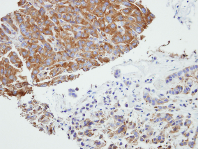 IHC of paraffin-embedded A549 xenograft using PRPSAP2 antibody at 1:500 dilution.