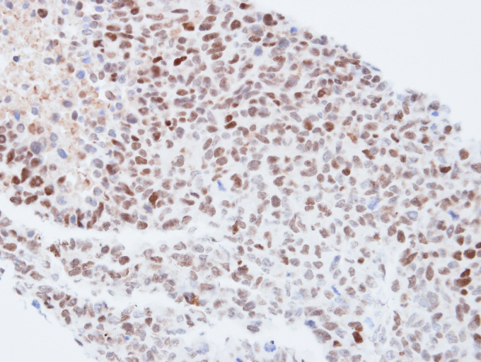 IHC of paraffin-embedded H1299 xenograft using KPNA4 antibody at 1:500 dilution.