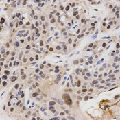 Immunohistochemistry of paraffin-embedded human esophageal cancer tissue using KPNA4 antibody at dilution of 1:200 (x400 lens).