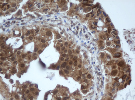 IHC of paraffin-embedded Adenocarcinoma of Human breast tissue using anti-PRR11 mouse monoclonal antibody. (Heat-induced epitope retrieval by 10mM citric buffer, pH6.0, 100C for 10min).