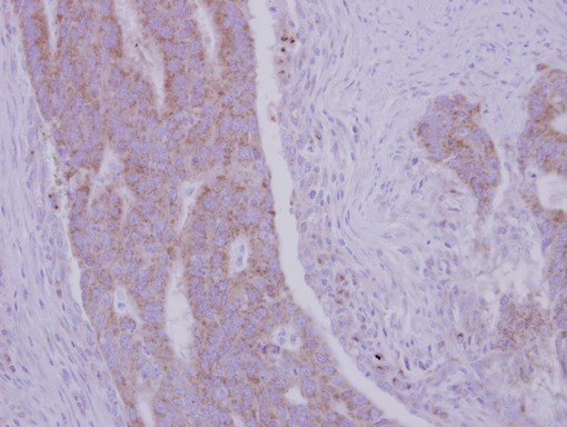 IHC of paraffin-embedded Colon ca, using RRM1 antibody at 1:500 dilution.