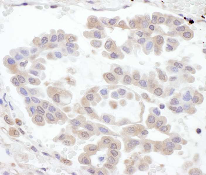 Detection of Human RABGEF1 by Immunohistochemistry. Sample: FFPE section of human lung carcinoma. Antibody: Affinity purified rabbit anti-RABGEF1 used at a dilution of 1:1000 (1 ug/ml). Detection: DAB.