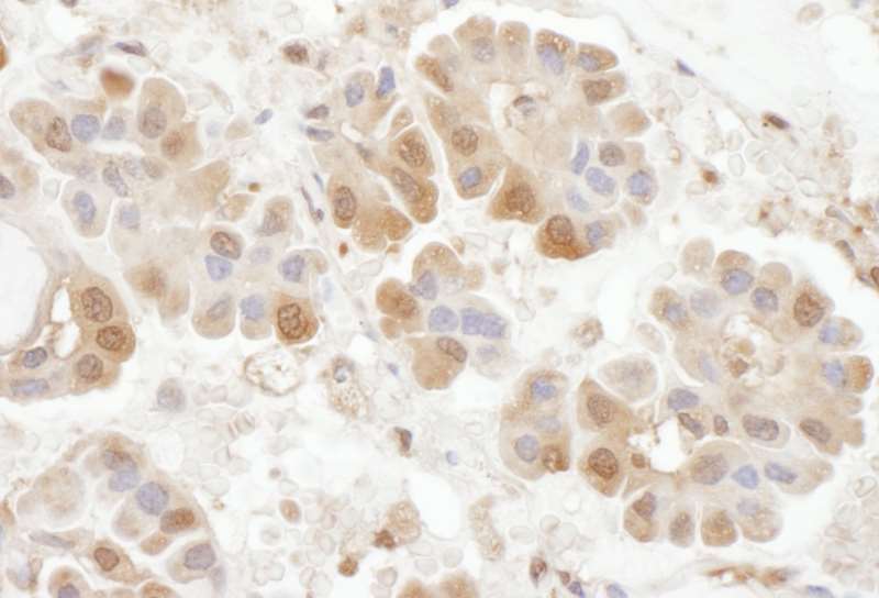 Detection of Human RABGEF1 by Immunohistochemistry. Sample: FFPE section of human lung carcinoma. Antibody: Affinity purified rabbit anti-RABGEF1 used at a dilution of 1:1000 (1 ug/ml). Detection: DAB.