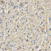 Immunohistochemistry of paraffin-embedded human kidney cancer using RACGAP1 antibody at dilution of 1:200 (x400 lens).