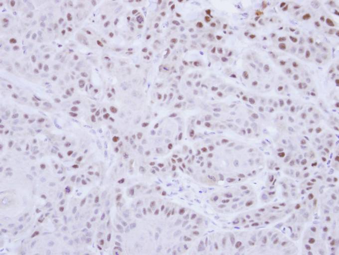 IHC of paraffin-embedded Cal27 Xenograft using RAD18 antibody at 1:100 dilution.