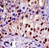 Formalin-fixed and paraffin-embedded human cancer tissue reacted with the primary antibody, which was peroxidase-conjugated to the secondary antibody, followed by DAB staining. This data demonstrates the use of this antibody for immunohistochemistry; clinical relevance has not been evaluated. BC = breast carcinoma; HC = hepatocarcinoma.