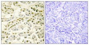 IHC of paraffin-embedded human pancreas tissue, using RAD51L1 Antibody. The picture on the right is treated with the synthesized peptide.