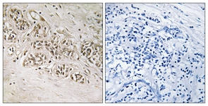 IHC of paraffin-embedded human breast carcinoma, using RAD54B Antibody. The picture on the right is treated with the synthesized peptide.
