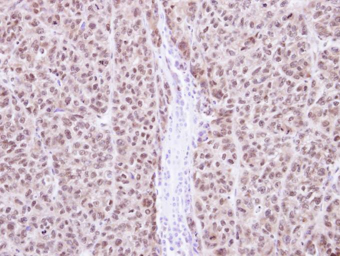IHC of paraffin-embedded DLD1 Xenograft using RAG2 antibody at 1:100 dilution.