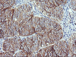 IHC of paraffin-embedded Adenocarcinoma of Human ovary tissue using anti-RALB mouse monoclonal antibody.