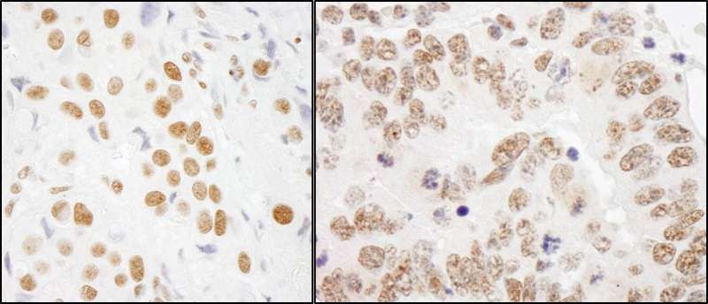 Detection of Human and Mouse RALY by Immunohistochemistry. Sample: FFPE section of human breast carcinoma (left) and mouse teratoma (right). Antibody: Affinity purified rabbit anti-RALY used at a dilution of 1:1000 (0.2 ug/ml) and 1:200 (1 ug/ml). Detection: DAB.