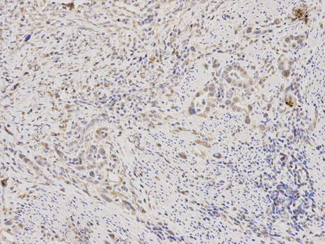 Immunohistochemistry of paraffin-embedded human stomach cancer using RAN antibody at dilution of 1:200 (400x lens).