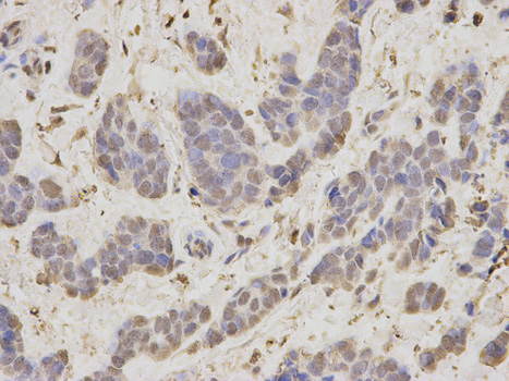 Immunohistochemistry of paraffin-embedded human breast cancer using RAN antibody at dilution of 1:200 (400x lens).