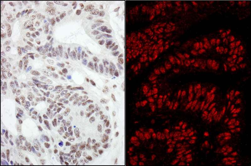 Detection of Human RanBP3 by Immunohistochemistry and Immunofluorescence. Sample: FFPE sections of human ovarian carcinoma (left) and colon carcinoma (right). Antibody: Affinity purified rabbit anti-RanBP3 used at a dilution of 1:200 (1 ug/ml) and 1:80 (2.5 ug/ml). Detection: DAB and Red-fluorescent Goat anti-Rabbit IgG-heavy and light chain, cross-adsorbed Antibody DyLight 594 Conjugated used at a dilution of 1:100.