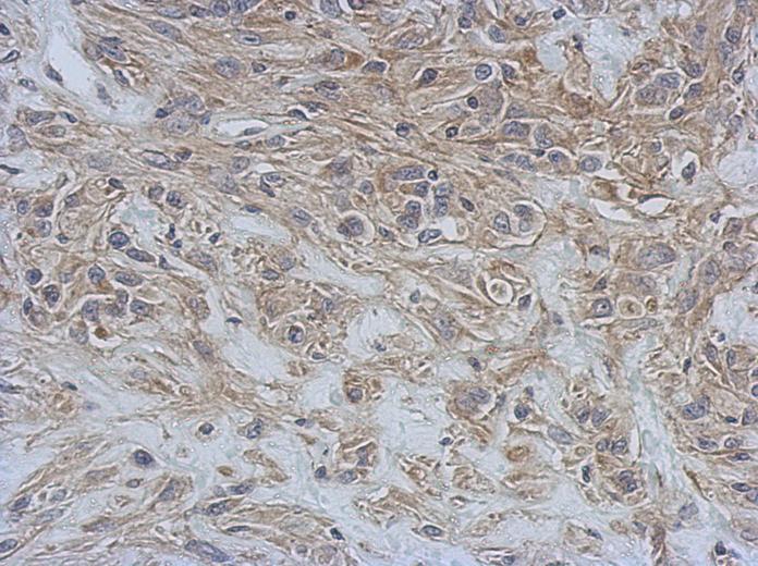 IHC of paraffin-embedded U373 xenograft, using RAP1GDS1 antibody at 1:500 dilution.