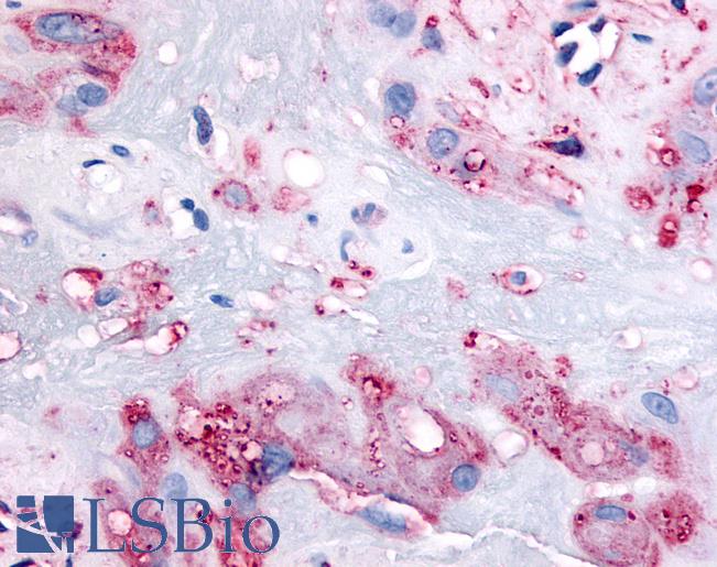 Anti-RARB antibody LS-A6086 IHC of human intermediate trophoblasts. Immunohistochemistry of formalin-fixed, paraffin-embedded tissue after heat-induced antigen retrieval.