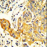 Formalin-fixed and paraffin-embedded human Lung carcinoma reacted with RARS2 Antibody , which was peroxidase-conjugated to the secondary antibody, followed by DAB staining. This data demonstrates the use of this antibody for immunohistochemistry; clinical relevance has not been evaluated.