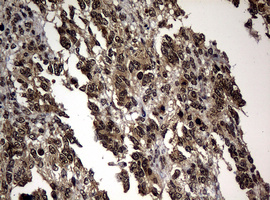 IHC of paraffin-embedded Adenocarcinoma of Human endometrium tissue using anti-RASGRP3 mouse monoclonal antibody.