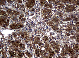 IHC of paraffin-embedded Carcinoma of Human liver tissue using anti-RASGRP3 mouse monoclonal antibody. (Heat-induced epitope retrieval by 10mM citric buffer, pH6.0, 120°C for 3min).