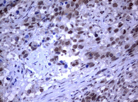 IHC of paraffin-embedded Adenocarcinoma of Human ovary tissue using anti-RASGRP3 mouse monoclonal antibody.