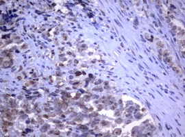 IHC of paraffin-embedded Adenocarcinoma of Human endometrium tissue using anti-RASGRP3 mouse monoclonal antibody.