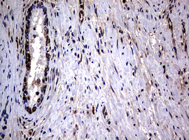 IHC of paraffin-embedded Carcinoma of Human prostate tissue using anti-RASGRP3 mouse monoclonal antibody.