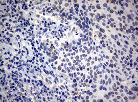 IHC of paraffin-embedded Carcinoma of Human lung tissue using anti-RASGRP3 mouse monoclonal antibody.