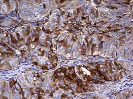 IHC of paraffin-embedded Adenocarcinoma of Human ovary tissue using anti-RASGRP3 mouse monoclonal antibody. (Heat-induced epitope retrieval by 10mM citric buffer, pH6.0, 120°C for 3min).