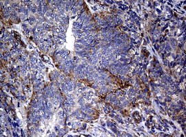 IHC of paraffin-embedded Adenocarcinoma of Human endometrium tissue using anti-RASGRP3 mouse monoclonal antibody. (Heat-induced epitope retrieval by 10mM citric buffer, pH6.0, 120°C for 3min).