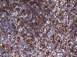 IHC of paraffin-embedded Human lymphoma tissue using anti-RASGRP3 mouse monoclonal antibody. (Heat-induced epitope retrieval by 10mM citric buffer, pH6.0, 120°C for 3min).