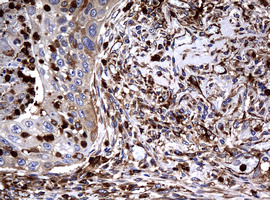 IHC of paraffin-embedded Carcinoma of Human lung tissue using anti-RASGRP3 mouse monoclonal antibody. (Heat-induced epitope retrieval by 10mM citric buffer, pH6.0, 120°C for 3min).