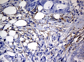 IHC of paraffin-embedded Adenocarcinoma of Human breast tissue using anti-RASGRP3 mouse monoclonal antibody. (Heat-induced epitope retrieval by 10mM citric buffer, pH6.0, 120°C for 3min).