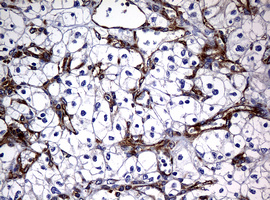IHC of paraffin-embedded Carcinoma of Human kidney tissue using anti-RASGRP3 mouse monoclonal antibody. (Heat-induced epitope retrieval by 10mM citric buffer, pH6.0, 120°C for 3min).