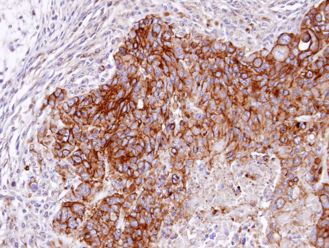 IHC of paraffin-embedded SW480 xenograft using RASGRP4 antibody at 1:100 dilution.