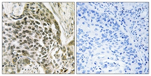 IHC of paraffin-embedded human lung carcinoma tissue, using RASSF7 Antibody. The sample on the right was incubated with synthetic peptide.