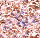 Formalin-fixed and paraffin-embedded human cancer tissue reacted with the primary antibody, which was peroxidase-conjugated to the secondary antibody, followed by DAB staining. This data demonstrates the use of this antibody for immunohistochemistry; clinical relevance has not been evaluated. BC = breast carcinoma; HC = hepatocarcinoma.