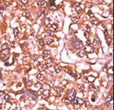 Formalin-fixed and paraffin-embedded human cancer tissue reacted with the primary antibody, which was peroxidase-conjugated to the secondary antibody, followed by AEC staining. This data demonstrates the use of this antibody for immunohistochemistry; clinical relevance has not been evaluated. BC = breast carcinoma; HC = hepatocarcinoma