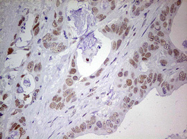 IHC of paraffin-embedded Adenocarcinoma of Human colon tissue using anti-PRRX1 mouse monoclonal antibody. (Heat-induced epitope retrieval by 10mM citric buffer, pH6.0, 120°C for 3min).